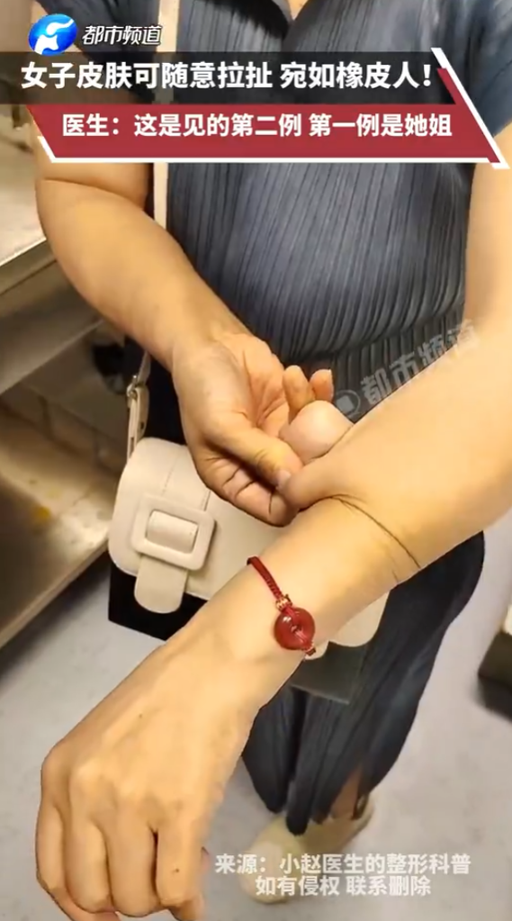 北京女有橡膠特異功能? 皮膚可拉伸近10cm醫生親解原因