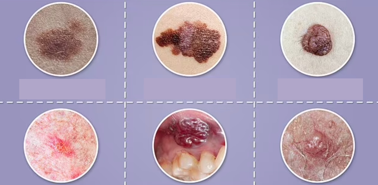 黑色素瘤的各種跡象。(互聯網)