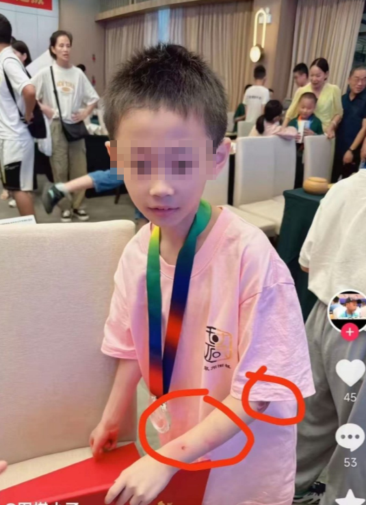 有網民發現朱宏鑫不但身體過於瘦弱,手臂上還有明顯傷痕。據指,在他出事前一天,其父曾更新朋友圈動態,稱兒子這次比賽一塌糊塗(網上圖片)