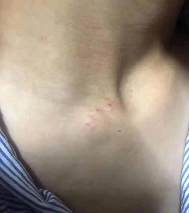 孩子頸上的掐痕。(微博)