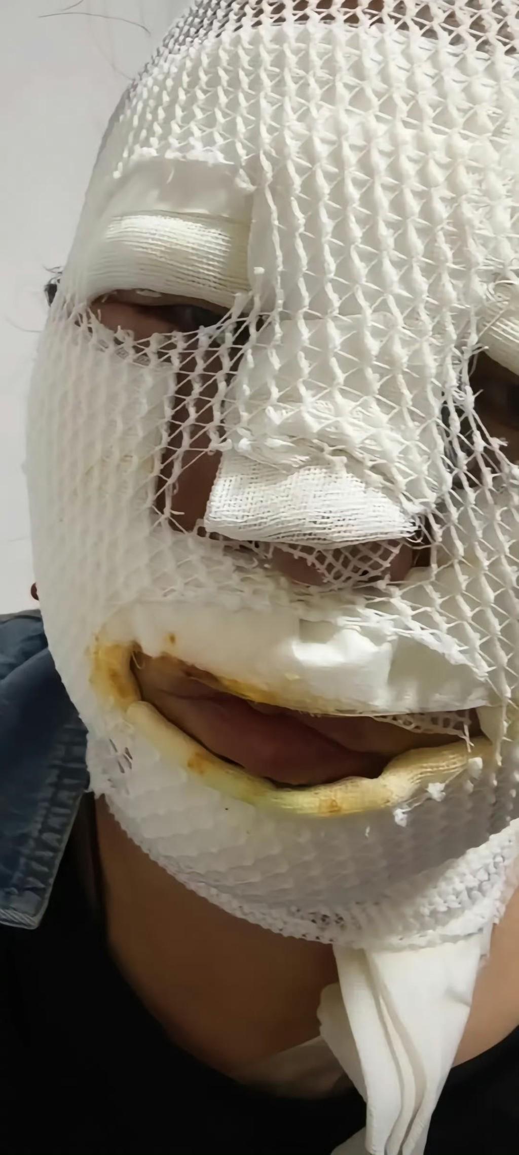 北京近日有市民野外燒烤時,所利用的手提卡式石油氣爐突然爆炸,造成兩家人7人不同程度燙傷。事後傷者臉部紮上繃帶被包成「木乃伊」。(微博)