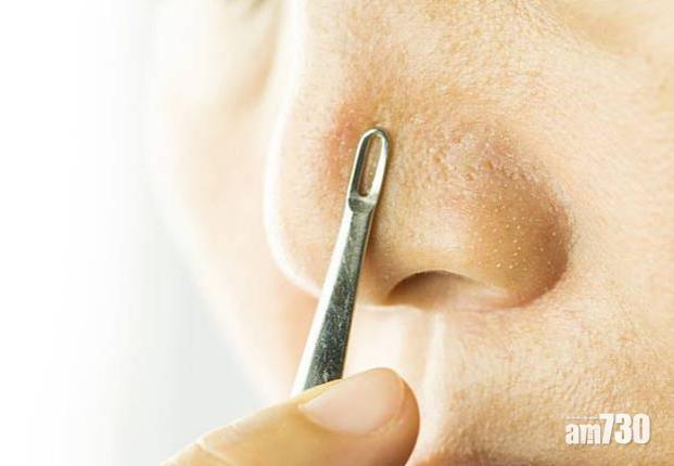 一般以擠壓或刮除的形式去除黑頭粉刺。