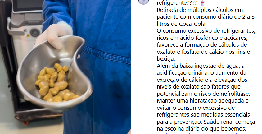 巴西男日喝3公升可樂 膀胱取出35粒大結石