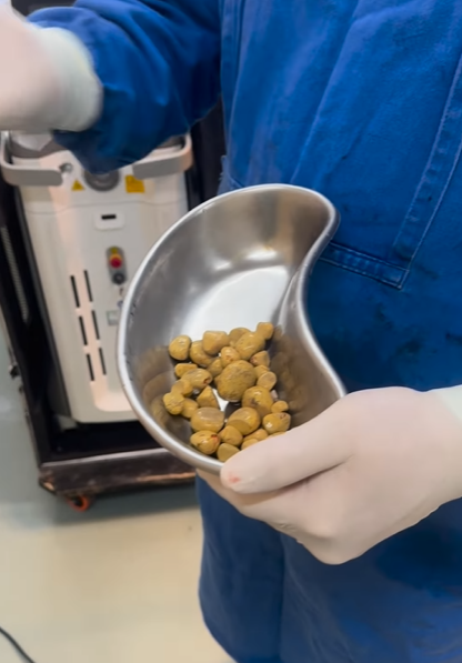 巴西男日喝3公升可樂 膀胱取出35粒大結石