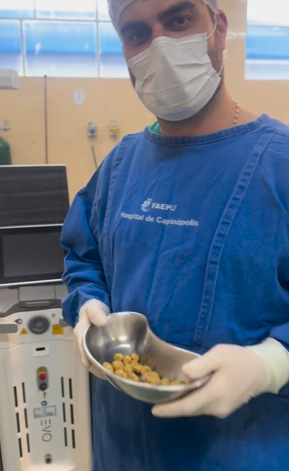 巴西男日喝3公升可樂 膀胱取出35粒大結石