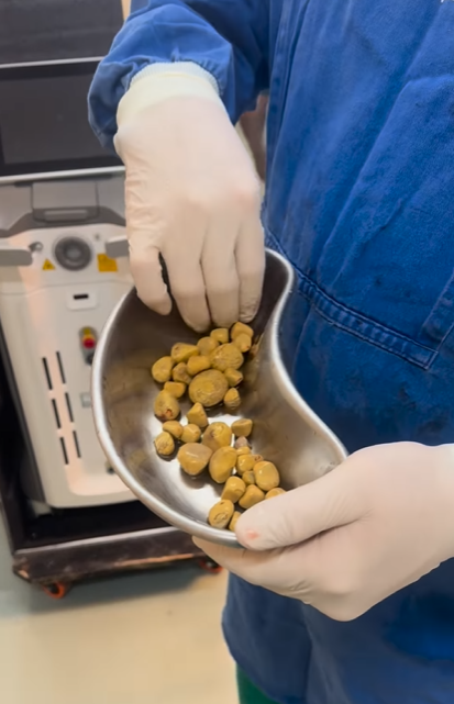 巴西男日喝3公升可樂 膀胱取出35粒大結石