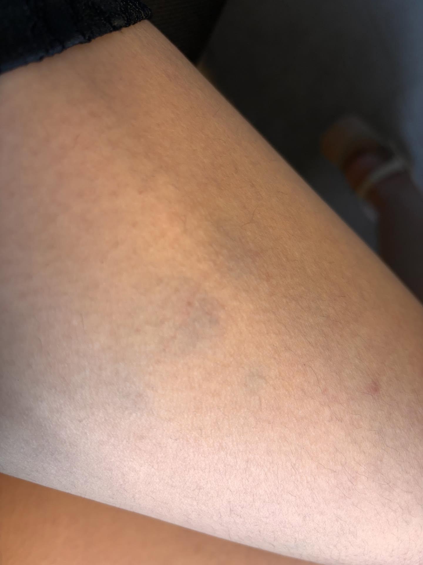 傷口位置(@Threads/ lanny_day49)