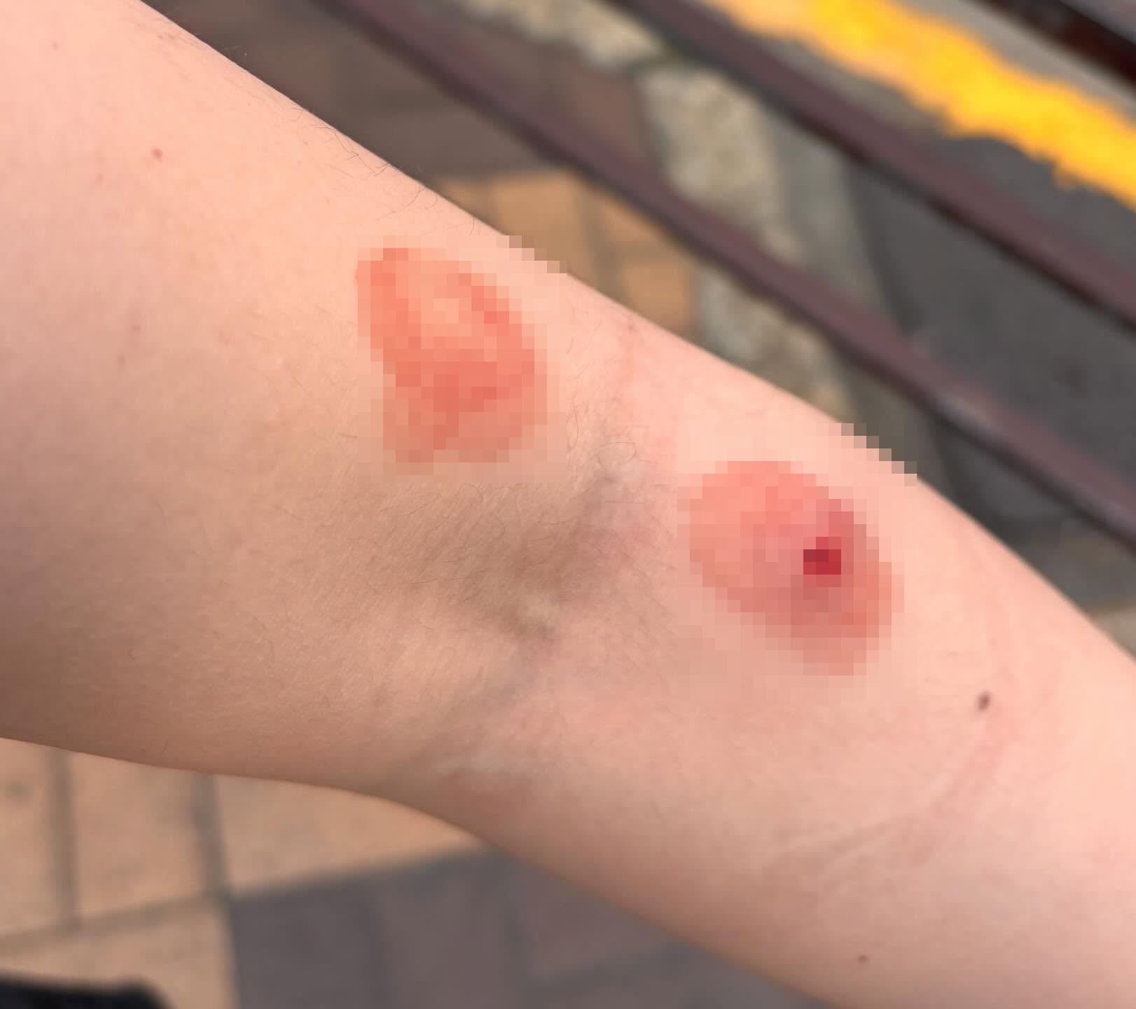 傷口位置(@Threads/ lanny_day49)