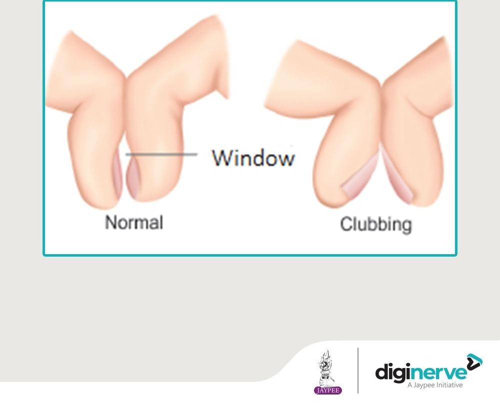 杵狀指檢測方法