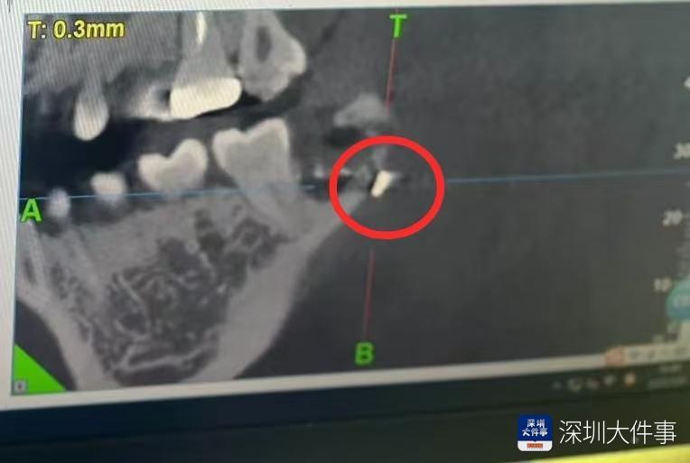 深圳一名女子,日前到一家牙醫診所拔智齒。不料回家後因為連續多日劇烈頭疼回診,一查竟發現當初手術針竟遺留在口腔內,讓她不得不接受全身麻醉取出。