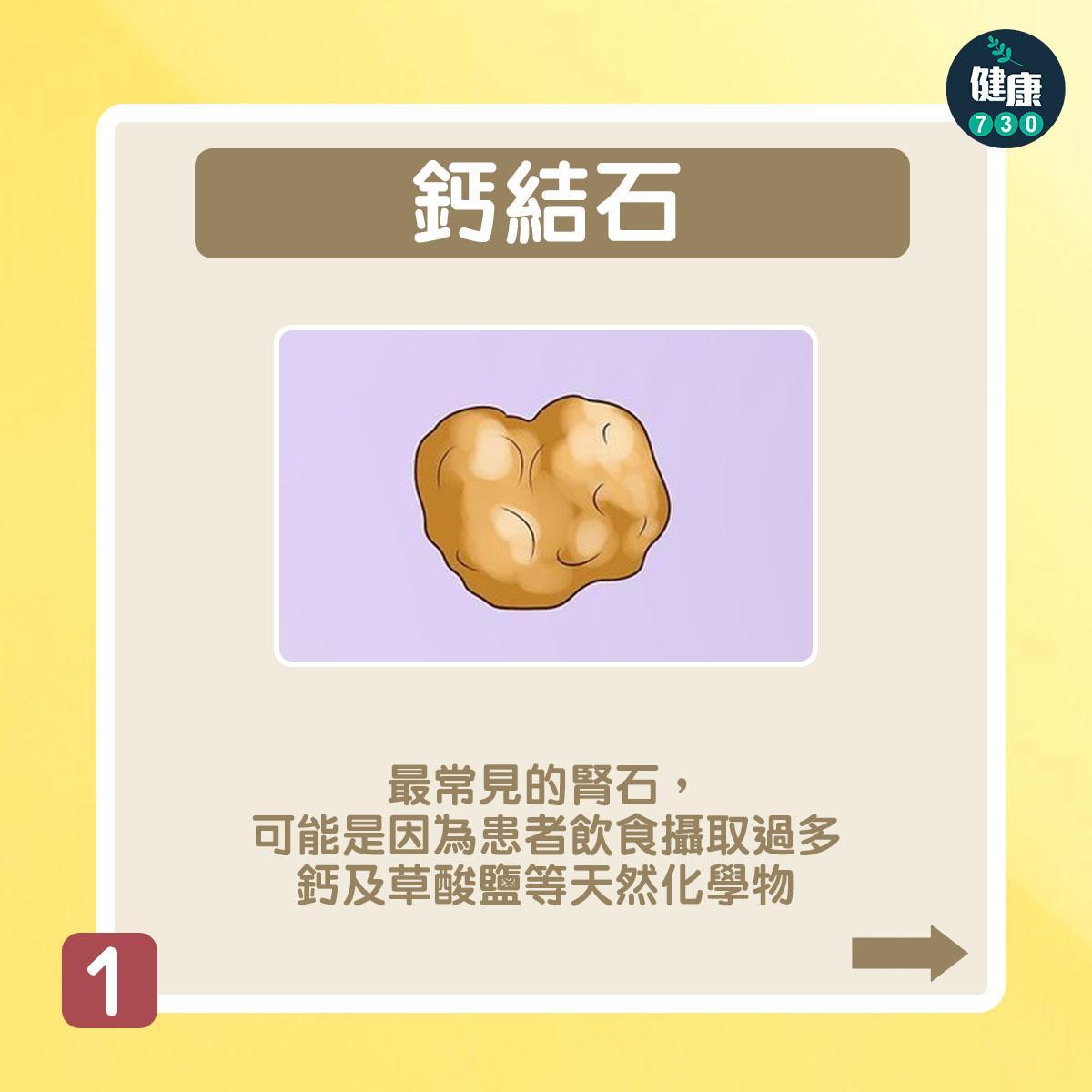 腎石種類|鈣結石(am730製圖)