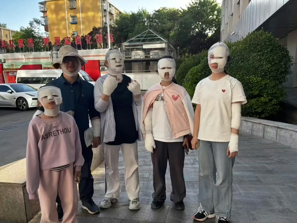 北京近日有市民野外燒烤時,所利用的手提卡式石油氣爐突然爆炸,造成兩家人7人不同程度燙傷。事後傷者臉部紮上繃帶被包成「木乃伊」。(微博)