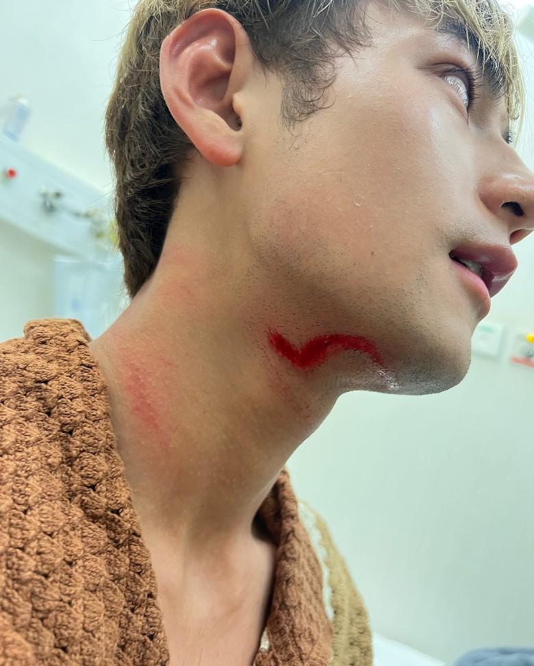 Jeffrey在社交網公開傷勢,嚇壞不少fans及網民。