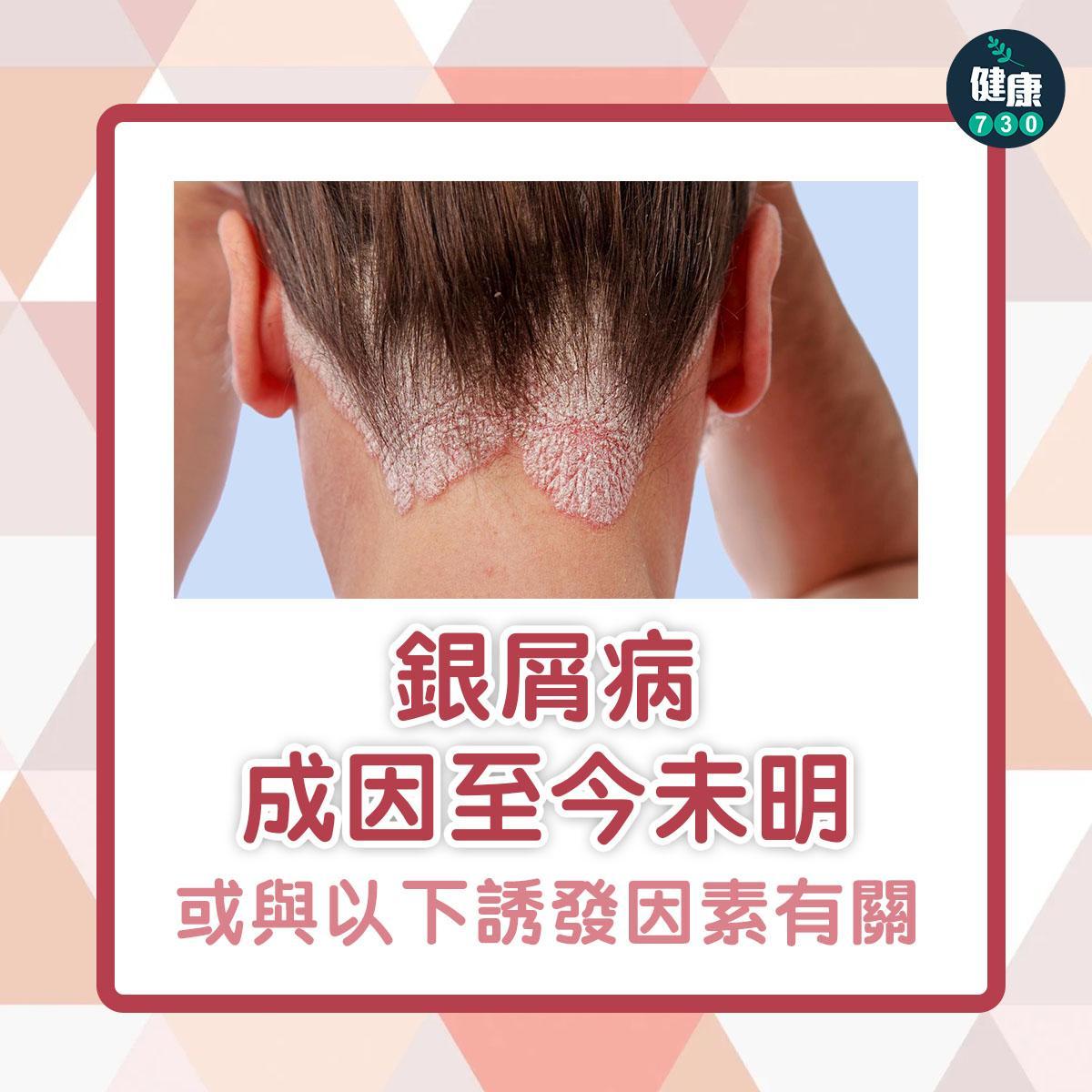 銀屑病原因|成因至今未明,但或與以下誘發因素有關(am730製圖)
