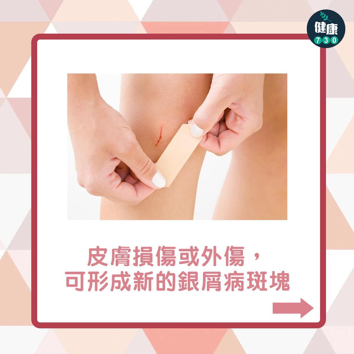 銀屑病原因|皮膚損傷或外傷,可形成新的銀屑病斑塊(am730製圖)