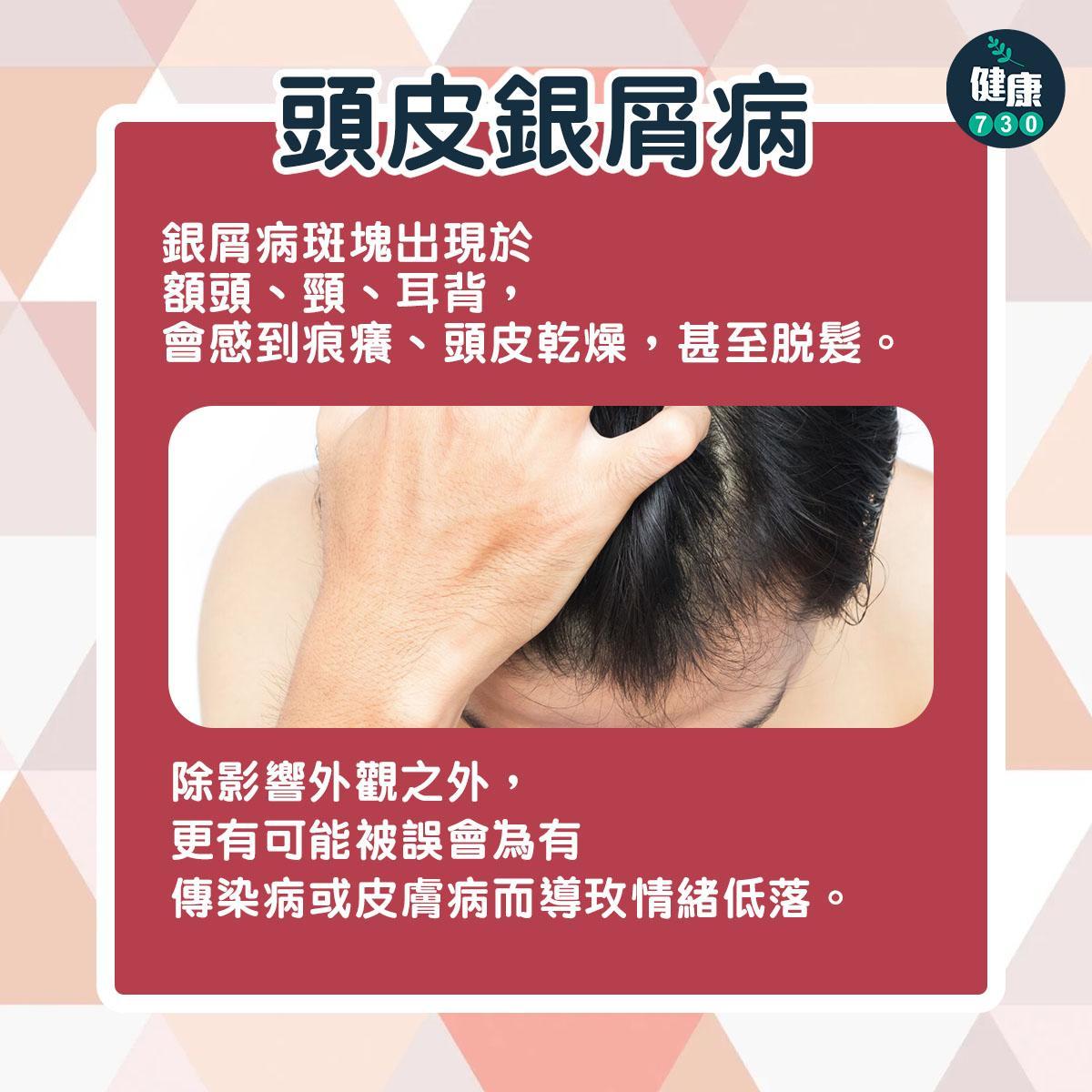 銀屑病種類|頭皮銀屑病(am730製圖)