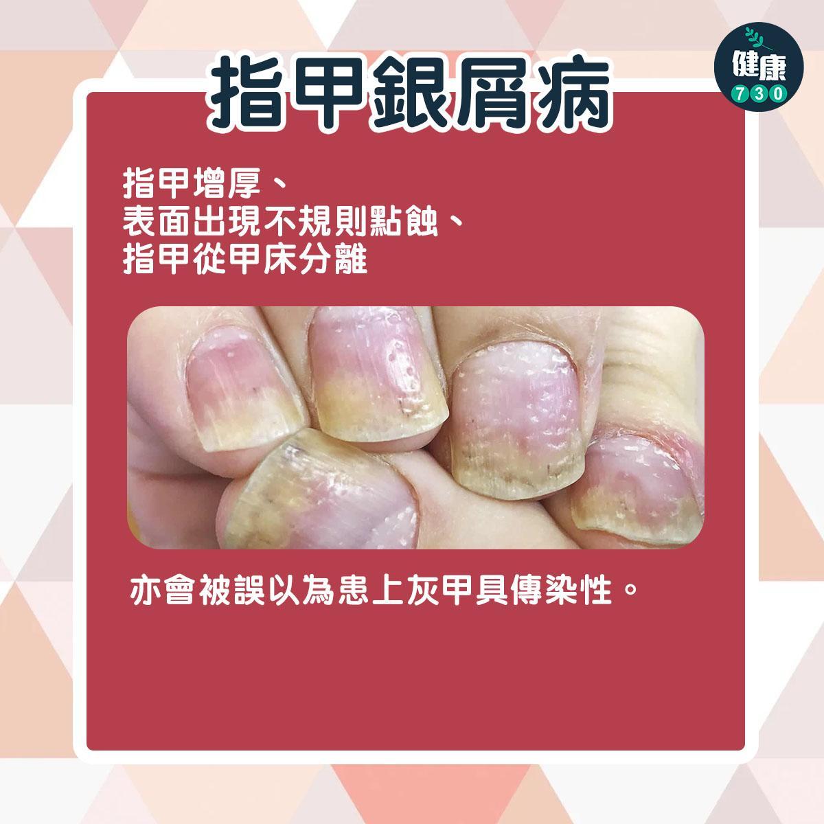 銀屑病種類|指甲銀屑病(am730製圖)