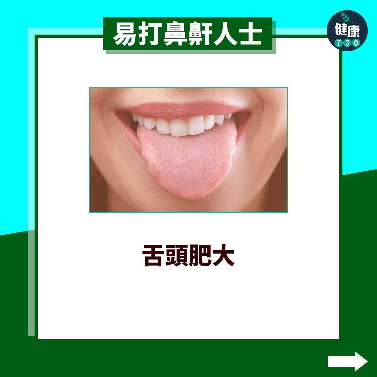 易打鼻鼾人士|舌頭肥大(am730製圖)