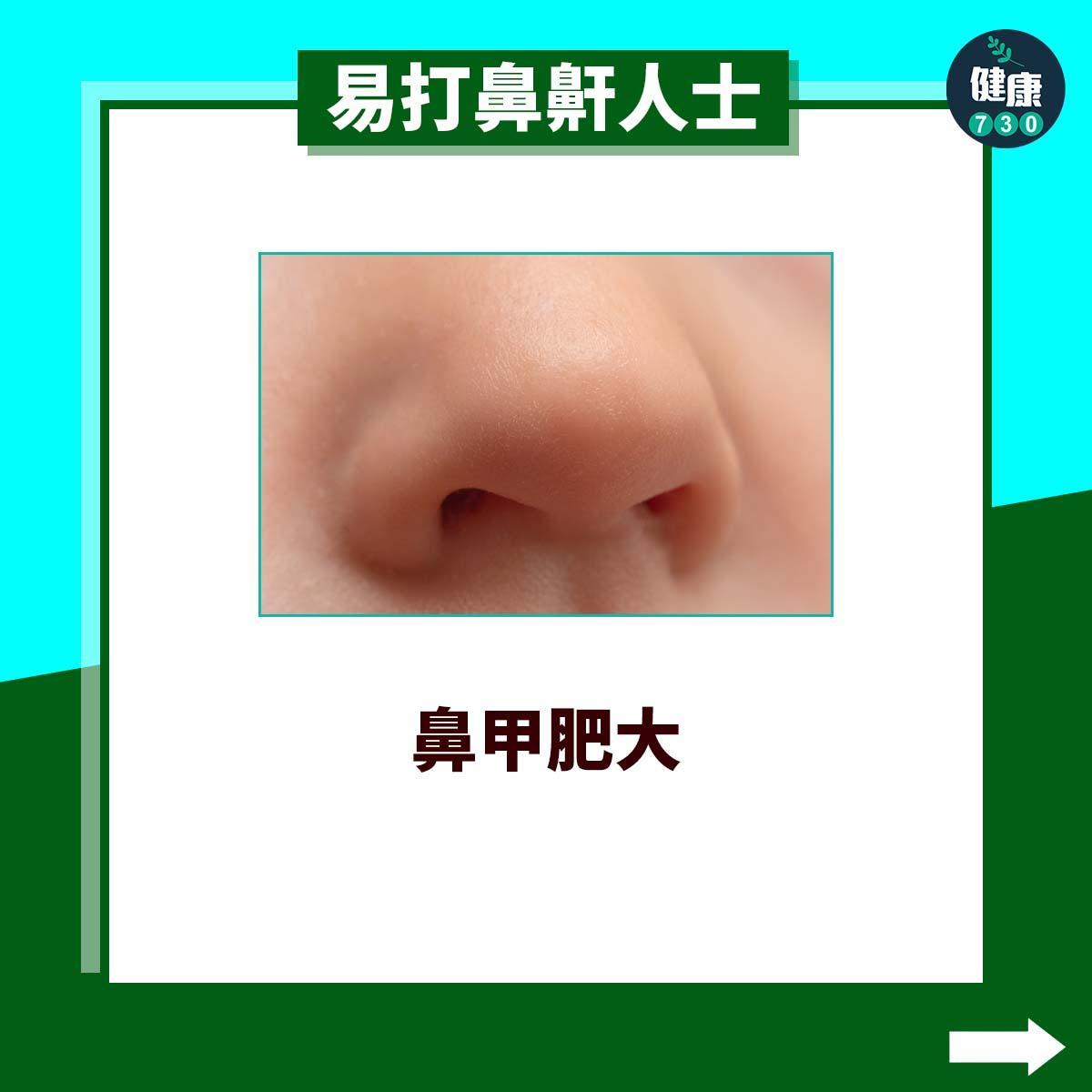 易打鼻鼾人士|鼻甲肥大(am730製圖)