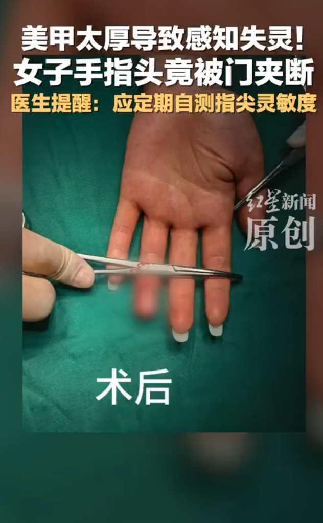 綜合內地媒體報道,這宗事故發生於5月底,女子劉佳在家中關門時,左手無名指被門夾住,導致皮膚破裂、大量出血,指尖當場離斷。她事後表示,意外發生時自己幾乎沒有明確的觸感,導致未能及時縮手。