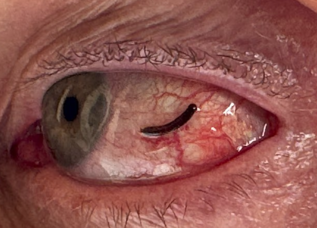 埃克索眼有水蛭。(互聯網)