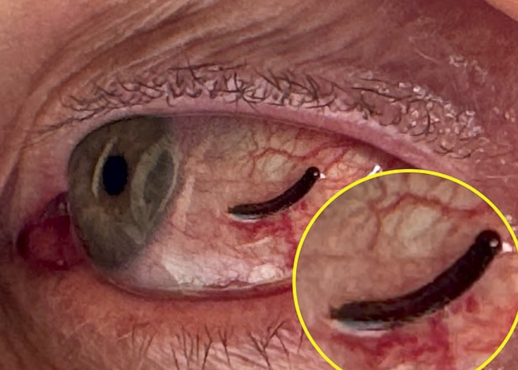 埃克索眼有水蛭。(互聯網)
