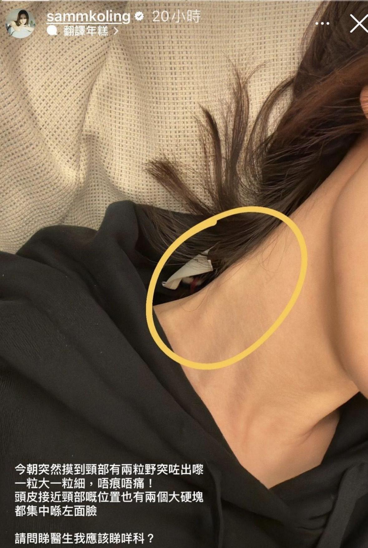 高海寧去年的頸部突然出現硬塊。