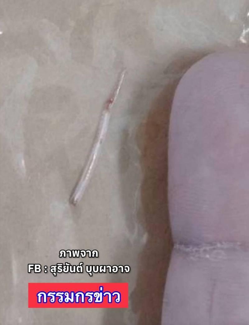 醫生最終透過手術,成功在她的頸部取出一條長約2厘米的魚骨。(X)