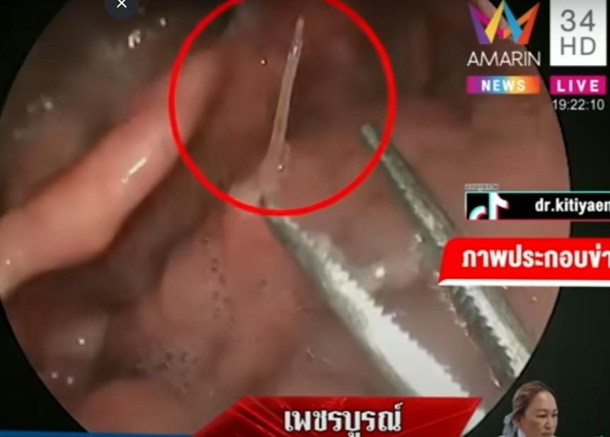 醫生最終透過手術,成功在她的頸部取出一條長約2厘米的魚骨。(X)