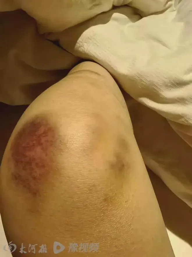 劉男前妻表示,自2014年結婚以來,丈夫頻頻賭博、家暴,「他常常不上班,去網吧打遊戲,甚至會將幾千塊工資全部拿去賭。」她指出,自2016年起,夫妻間爭執不斷,並多次演變成肢體衝突,她還稱劉男「多次用繩子捆綁我手腳」。