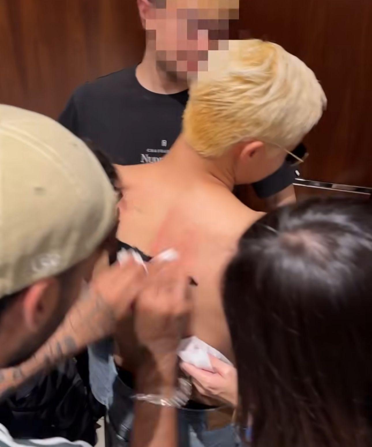 工作人員為Gareth T.捽甩背上大字時被擦到紅晒。