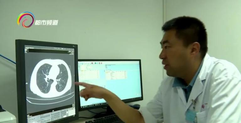 醫療團隊為老劉進行了頸動脈內膜斑塊切除術(CEA),手術歷時2小時,成功從血管內剥離出一個長達4公分的硬化斑塊。(網上圖片)