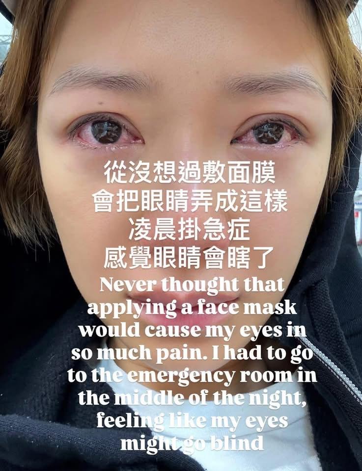 倪晨曦雙眼通紅滿佈紅筋,眼皮浮腫,雙眼不停流出淚水。