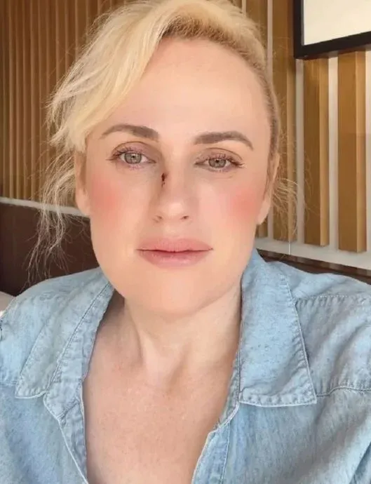 Rebel Wilson自嘲把險些毀容的照片放上網,不及她的減肥自拍獲更多like數。