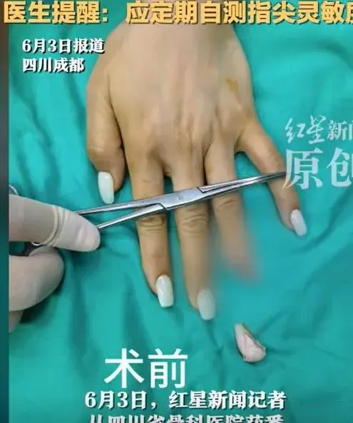 綜合內地媒體報道,這宗事故發生於5月底,女子劉佳在家中關門時,左手無名指被門夾住,導致皮膚破裂、大量出血,指尖當場離斷。她事後表示,意外發生時自己幾乎沒有明確的觸感,導致未能及時縮手。