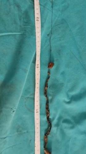 毛球裡混雜毛線、橡筋、木屑、小石頭等異物。(互聯網)