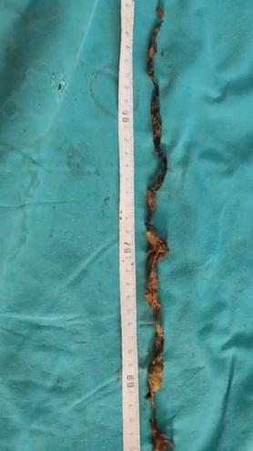 毛球裡混雜毛線、橡筋、木屑、小石頭等異物。(互聯網)