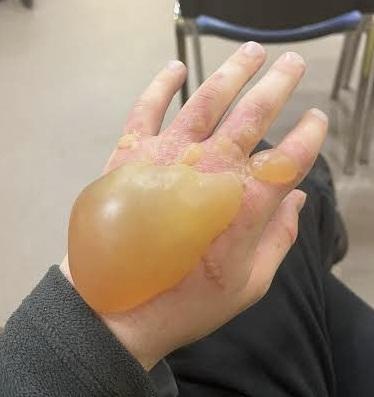 接觸大豕草後,誤觸後手部紅腫,起巨大水泡。(互聯網)