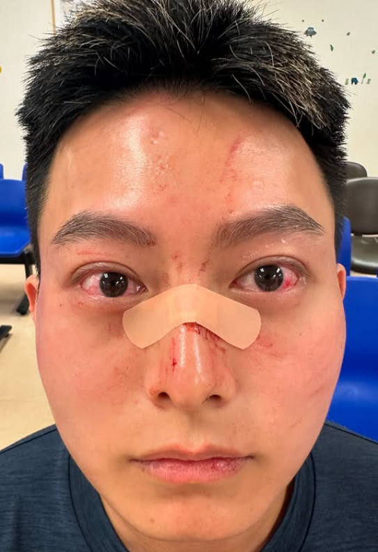 葉子健事後在社交平台Instagram上傳多則限時動態,他當時正在一間食肆與友人「打邊爐」;及後他鼻上染血並貼有膠布登上救護車稱:「頭先打邊爐嘅時候呢,劉馬車打咗我幾拳,打到我瞓低咗,而家上白車。」他在醫院亦與友人拍下合照,可見其上衣背後位置損毀。