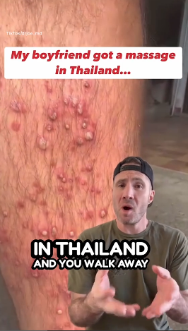 泰國按摩變惡夢 男子翌日醒來小腿布滿膿瘡
