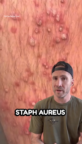 泰國按摩變惡夢 男子翌日醒來小腿布滿膿瘡