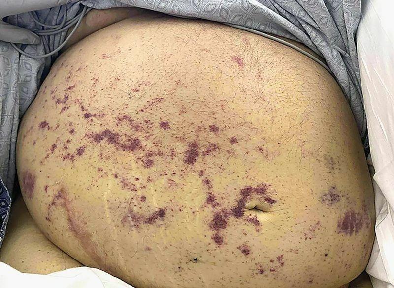 男子不僅出現呼吸衰竭與休克,皮膚上還出現星芒狀紫色皮疹。(NEJM)