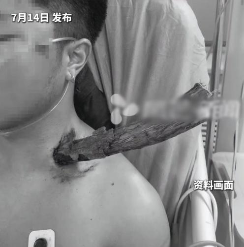 男子被1枝直徑約3公分的枯樹枝插中頸。(微博)