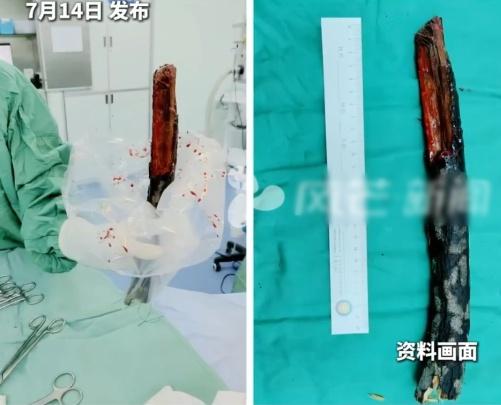 歷經數小時,這場高難度手術以「零血管損傷」順利結束。(微博)