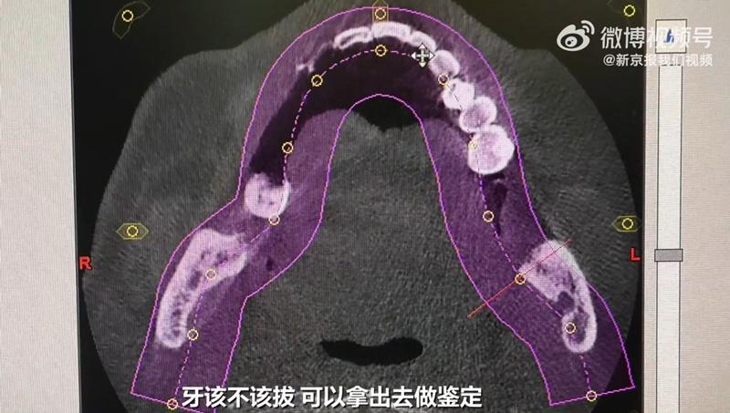 一口氣剝12隻牙。(微博)