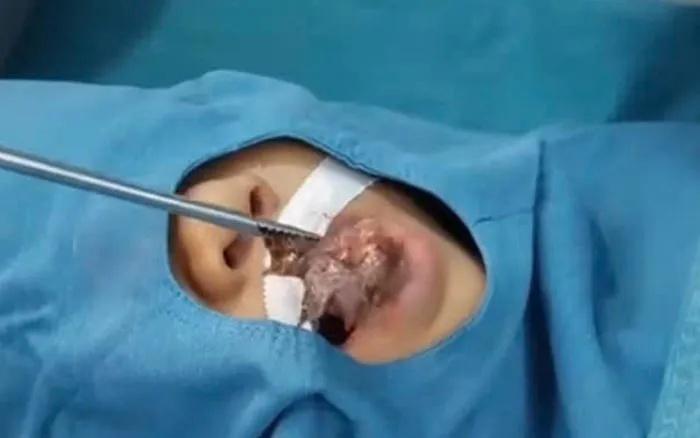 醫生取出一條長7厘米、還活著且帶有尖刺魚鰭的攀鱸魚。(X)