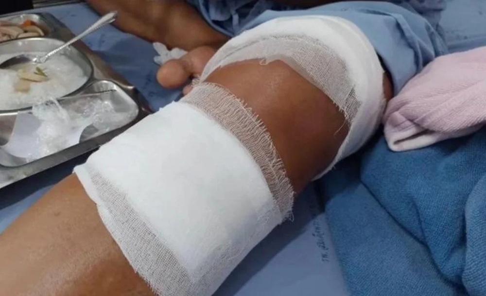 婦人被咬中左腿,傷口深可見骨,劇痛得幾乎暈倒。(FB)