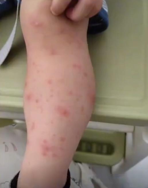 女事主表示,兒子當晚突發高燒至攝氏39度,3天後被確診為水痘,四肢出現大量紅色皰疹。(微博)