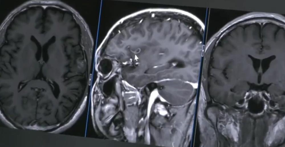 透過影像可以看到蟲體正緩慢向大腦深部移動。(微博)