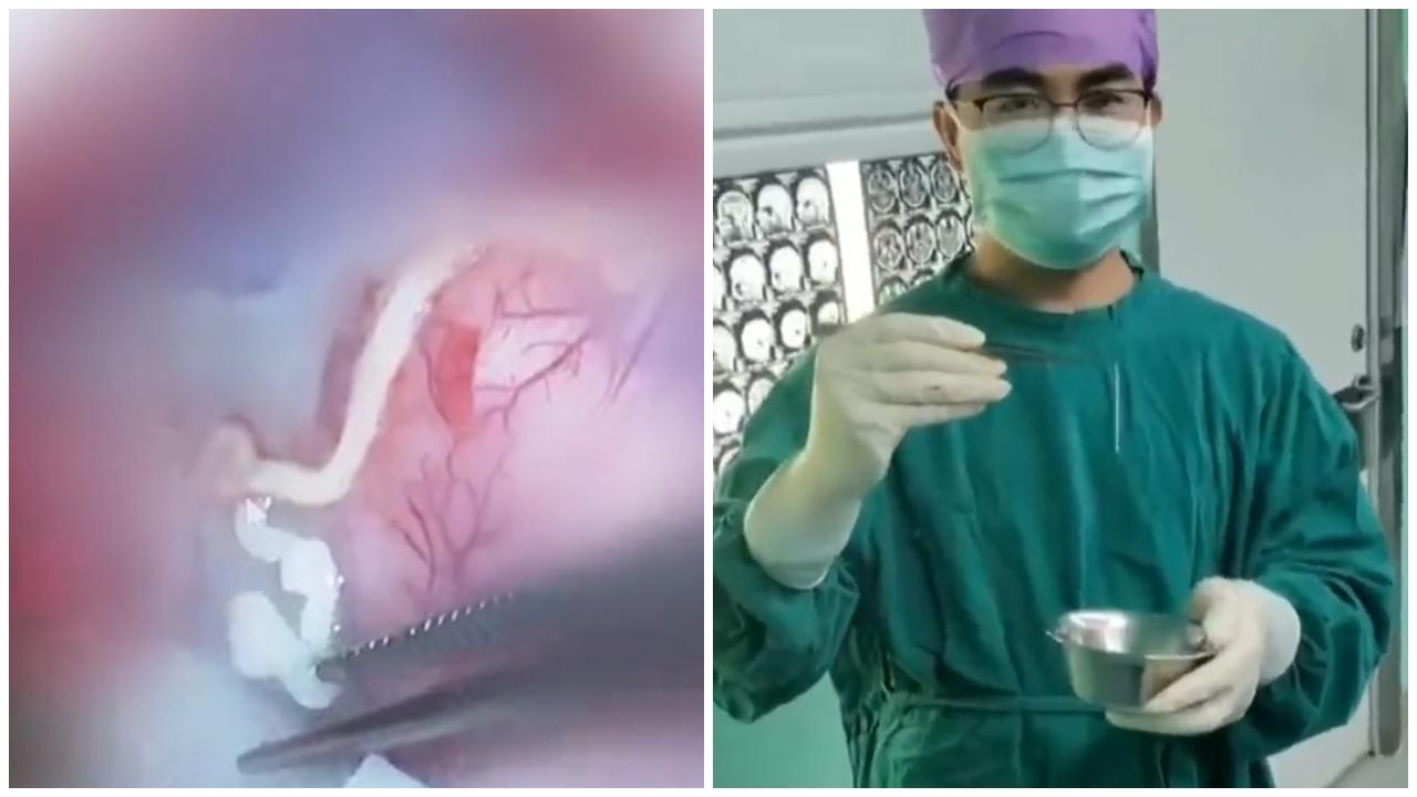 男子釣魚突抽搐失語,開腦驚見10厘米活蟲蠕動。(微博)